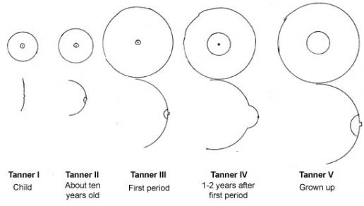 Tanner stages of breast maturation